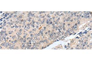 Immunohistochemistry of paraffin-embedded Human prost at e cancer tissue using MOB1B Polyclonal Antibody at dilution of 1:25(x200) (MOBKL1A Antikörper)