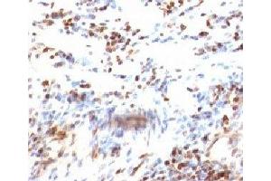 Formalin-fixed, paraffin-embedded human colon carcinoma stained with p27Kip1 antibody (KIP1/769) (CDKN1B Antikörper)