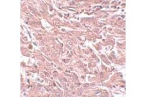 Immunohistochemistry of BCAS4 in human breast carcinoma with BCAS4 antibody at 5 μg/ml. (BCAS4 Antikörper  (N-Term))