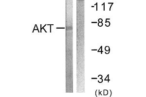 Immunohistochemistry analysis of paraffin-embedded human breast carcinoma tissue using Akt (Ab-326) antibody. (AKT1 Antikörper)