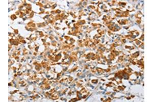 The image on the left is immunohistochemistry of paraffin-embedded Human thyroid cancer tissue using ABIN7128507(ARHGEF9 Antibody) at dilution 1/50, on the right is treated with fusion protein. (Arhgef9 Antikörper)