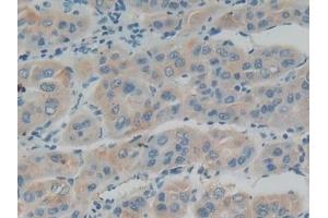 Detection of IFNa/bR1 in Human Liver cancer Tissue using Polyclonal Antibody to Interferon Alpha/Beta Receptor 1 (IFNa/bR1) (IFNAR1 Antikörper  (AA 28-227))