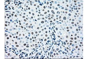 Immunohistochemical staining of paraffin-embedded Adenocarcinoma of ovary tissue using anti-MAP2K2mouse monoclonal antibody. (MEK2 Antikörper)