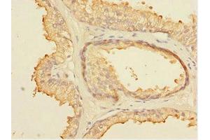 Immunohistochemistry of paraffin-embedded human prostate cancer using ABIN7152099 at dilution of 1:100 (ELF5 Antikörper  (AA 1-170))