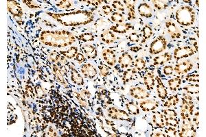 ABIN6258750 and ABIN6274361 at 1/100 staining Human kidney cancer and adjacent normal tissues by IHC-P.