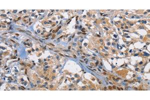 Immunohistochemistry of paraffin-embedded Human thyroid cancer using c-Fos Polyclonal Antibody at dilution of 1:70 (c-FOS Antikörper)
