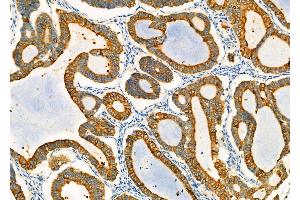 ABIN6259828 and ABIN6278001 at 1/100 staining Human ovarian cancer by IHC-P. (AGR2 Antikörper  (N-Term))