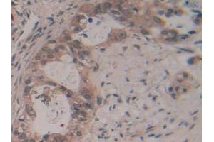 IHC-P analysis of Human Pancreas Cancer Tissue, with DAB staining. (GAP43 Antikörper  (AA 1-274))