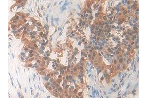 Detection of PDXK in Human Lung cancer Tissue using Polyclonal Antibody to Pyridoxal Kinase (PDXK) (PDXK Antikörper  (AA 29-253))