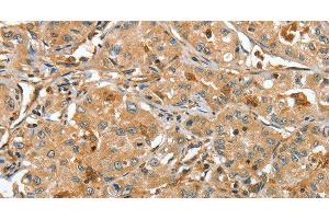 Immunohistochemistry of paraffin-embedded Human lung cancer tissue using RAP1A Polyclonal Antibody at dilution 1:45 (RAP1A Antikörper)