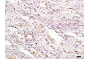Formalin-fixed and paraffin embedded human cervical carcinoma labeled with Anti MIIP Polyclonal Antibody, Unconjugated  at 1:200 followed by conjugation to the secondary antibody and DAB staining (MIIP Antikörper  (AA 251-350))