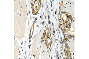 Immunohistochemistry of paraffin-embedded human stomach cancer using IL9 antibody. (IL-9 Antikörper)