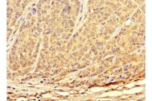 Immunohistochemistry of paraffin-embedded human ovarian cancer using ABIN7172897 at dilution of 1:100 (TKTL2 Antikörper  (AA 1-300))