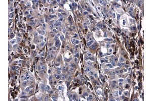 IHC-P Image Urokinase antibody detects Urokinase protein at cytoplasm and extracellular space in human esophageal carcinoma by immunohistochemical analysis. (PLAU Antikörper)