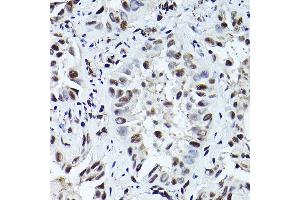 Immunohistochemistry of paraffin-embedded human lung cancer using Phospho-ATR-T1989 Rabbit pAb (ABIN7265777) at dilution of 1:200 (40x lens). (ATR Antikörper  (pThr1989))