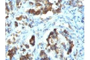 IHC testing of FFPE human gastric carcinoma with Cdc20 antibody (clone CLDC20-1) (CDC20 Antikörper)