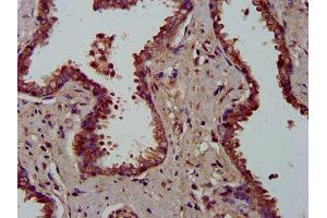IHC image of ABIN7159706 diluted at 1:300 and staining in paraffin-embedded human prostate cancer performed on a Leica BondTM system. (MFAP4 Antikörper  (AA 100-191))