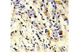 IHC analysis of FFPE human breast carcinoma stained with IGHM antibody (IGHM Antikörper  (AA 103-131))
