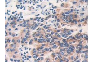 Detection of ETFb in Human Prostate cancer Tissue using Polyclonal Antibody to Electron Transfer Flavoprotein Beta Polypeptide (ETFb)