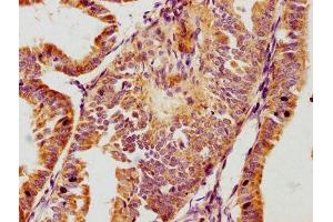 IHC image of ABIN7163242 diluted at 1:100 and staining in paraffin-embedded human endometrial cancer performed on a Leica BondTM system. (GPLD1 Antikörper  (AA 310-565))