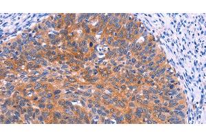 Immunohistochemistry of paraffin-embedded Human cervical cancer tissue using PTPN13 Polyclonal Antibody at dilution 1:30 (PTPN13 Antikörper)