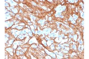 Formalin-fixed, paraffin-embedded human colon carcinoma stained with Periostin (POSTN) Mouse Monoclonal Antibody (POSTN/3501). (Periostin Antikörper  (AA 193-326))