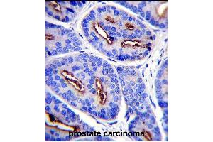 FOLH1 Antibody (N-term) (ABIN657630 and ABIN2846626) immunohistochemistry analysis in formalin fixed and paraffin embedded human prostate carcinoma followed by peroxidase conjugation of the secondary antibody and DAB staining. (PSMA Antikörper  (N-Term))