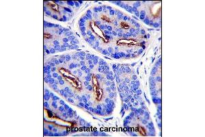FOLH1 Antibody (N-term) (ABIN657630 and ABIN2846626) immunohistochemistry analysis in formalin fixed and paraffin embedded human prostate carcinoma followed by peroxidase conjugation of the secondary antibody and DAB staining.