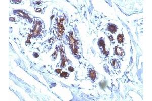 Formalin-fixed, paraffin-embedded human breast carcinoma stained with Lactadherin antibody (EDM45) (MFGE8 Antikörper)