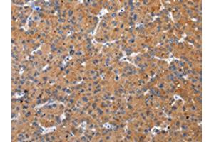 The image on the left is immunohistochemistry of paraffin-embedded Human liver cancer tissue using ABIN7193094(ZFAND2A Antibody) at dilution 1/30, on the right is treated with synthetic peptide. (ZFAND2A Antikörper)