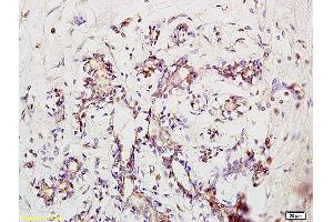 Formalin-fixed and paraffin embedded human pneumonia tissue labeled with Anti-Phospho-IRAK1 (Ser376) Polyclonal Antibody, Unconjugated at 1:200 followed by conjugation to the secondary antibody and DAB staining (IRAK1 Antikörper  (pSer376))