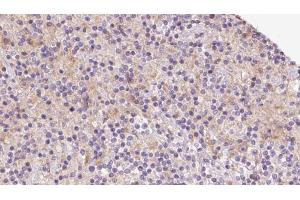 ABIN6273080 at 1/100 staining Human lymph cancer tissue by IHC-P. (TIMM22 Antikörper  (Internal Region))