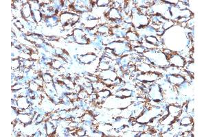 Formalin-fixed, paraffin-embedded human Angiosarcoma stained with Smooth Muscle Actin MAb (1A4 + ACTA2/791). (Smooth Muscle Actin Antikörper  (N-Term))