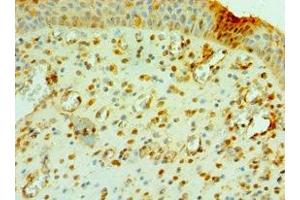 Immunohistochemistry of paraffin-embedded human prostate cancer using ABIN7147105 at dilution of 1:100 (CNOT8 Antikörper  (AA 1-292))