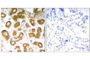 Immunohistochemical analysis of paraffin-embedded human breast carcinoma tissue using NFκB-p65 (Ab-505) Antibody (E021178). (NF-kB p65 Antikörper)