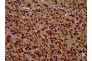 IHC image of ABIN7176659 diluted at 1:400 and staining in paraffin-embedded human glioma performed on a Leica BondTM system. (ZFX Antikörper  (AA 711-805))