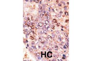 Formalin-fixed and paraffin-embedded human hepatocellular carcinoma tissue reacted with ABCB7 polyclonal antibody  , which was peroxidase-conjugated to the secondary antibody, followed by DAB staining. (ABCB7 Antikörper  (C-Term))