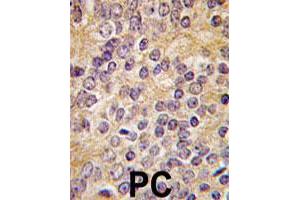 Formalin-fixed and paraffin-embedded human prostate carcinoma tissue reacted with PLAU polyclonal antibody  , which was peroxidase-conjugated to the secondary antibody, followed by DAB staining. (PLAU Antikörper  (C-Term))