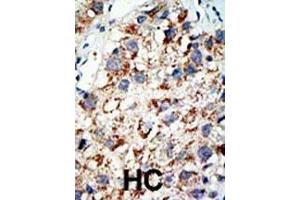 Formalin-fixed and paraffin-embedded human cancer tissue reacted with the primary antibody, which was peroxidase-conjugated to the secondary antibody, followed by AEC staining. (UBA2 Antikörper  (C-Term))