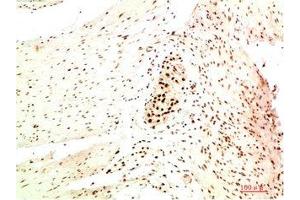 Immunohistochemical analysis of paraffin-embedded Human Colon Carcinoma Tissue using HP-1 α Mouse mAb diluted at 1:200. (CBX5 Antikörper)