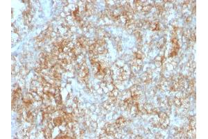 Formalin-fixed, paraffin-embedded human Renal Cell Carcinoma stained with CD147 Mouse Monoclonal Antibody (8D6). (CD147 Antikörper)