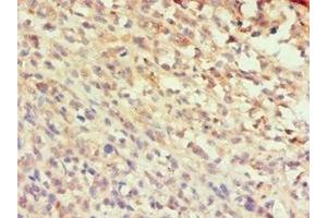Immunohistochemistry of paraffin-embedded human melanoma using ABIN7145991 at dilution of 1:100 (CCL25 Antikörper  (AA 24-150))