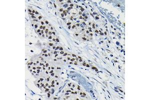 Immunohistochemistry of paraffin-embedded human lung cancer using A Rabbit pAb (ABIN6131196, ABIN6137102, ABIN6137103 and ABIN6223591) at dilution of 1:100 (40x lens). (ARID3A Antikörper  (AA 324-593))