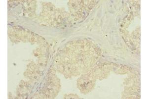 Immunohistochemistry of paraffin-embedded human prostate cancer using ABIN7174808 at dilution of 1:100 (C20orf195 Antikörper  (AA 10-310))