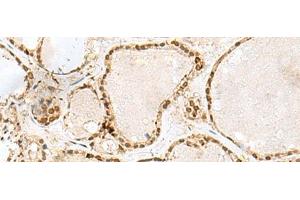 Immunohistochemistry of paraffin-embedded Human thyroid cancer tissue using GTF3C2 Polyclonal Antibody at dilution of 1:45(x200) (GTF3C2 Antikörper)