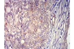 Immunohistochemical analysis of paraffin-embedded cervical cancer tissues using CD156 mouse mAb with DAB staining. (ADAM8 Antikörper  (AA 17-156))