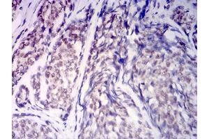 Immunohistochemical analysis of paraffin-embedded esophageal cancer tissues using KDM1A mouse mAb with DAB staining. (LSD1 Antikörper  (AA 709-876))