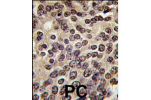 Formalin-fixed and paraffin-embedded human prostate carcinoma tissue reacted with PKN3 polyclonal antibody  , which was peroxidase-conjugated to the secondary antibody, followed by DAB staining. (PKN3 Antikörper  (C-Term))