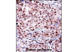 TERF2IP Antibody (C-term) ((ABIN657968 and ABIN2846914))immunohistochemistry analysis in formalin fixed and paraffin embedded human breast carcinoma followed by peroxidase conjugation of the secondary antibody and DAB staining.