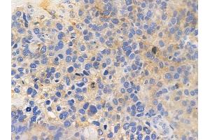 ABIN6261857 and ABIN6277969 at 1/100 staining human glioblastoma by IHC-P. (GABBR2 Antikörper  (C-Term))